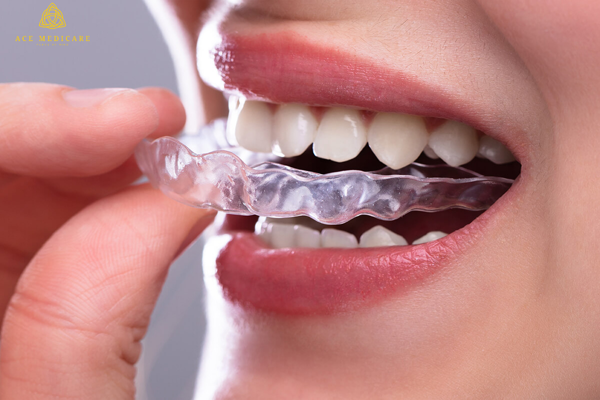 The Cost of Clear Aligners: What to Expect and How to Budget